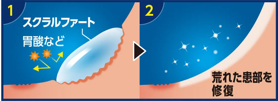 スクラルファートが胃酸など荒れた患部を修復